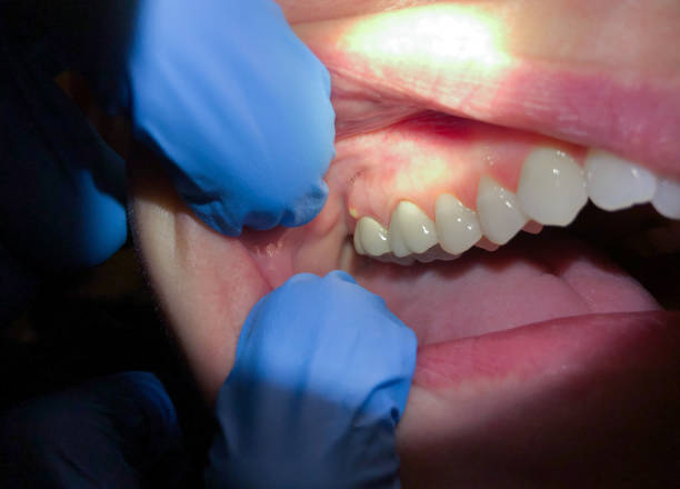 Best Emergency Broken Tooth Repair in Tatum, TX